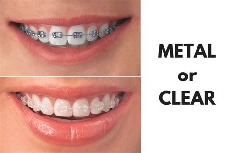 clear bracket braces vs metal|ceramic braces vs metal cost.